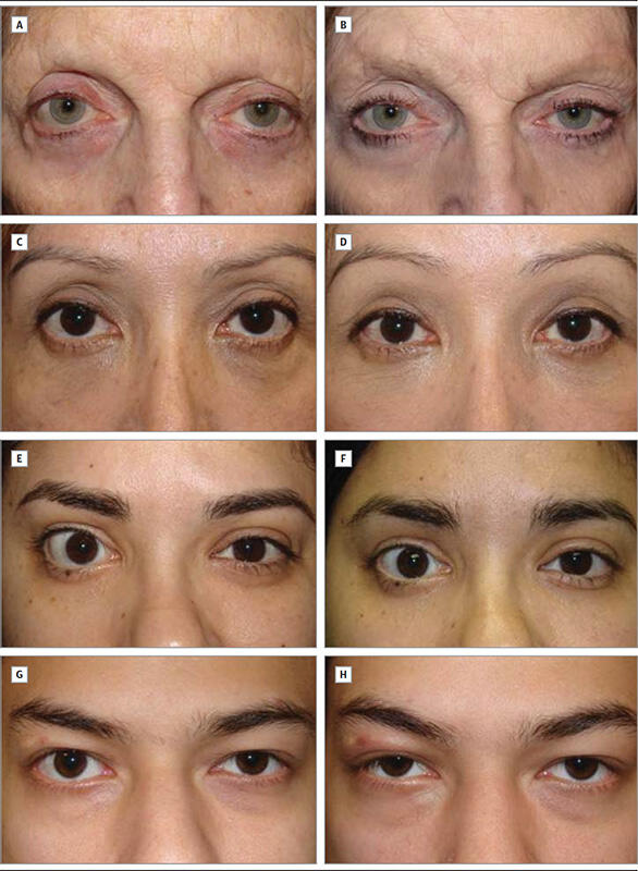 Lower Eyelid Recession Procedure Before and Afters
