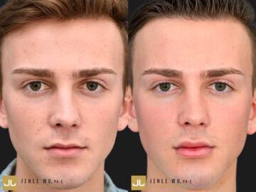 Before and After Photo of Microneedling Procedure Results (Frontal View)
