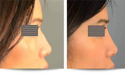 2nd Before and After Photo of Non Surgical Rhinoplasty Results