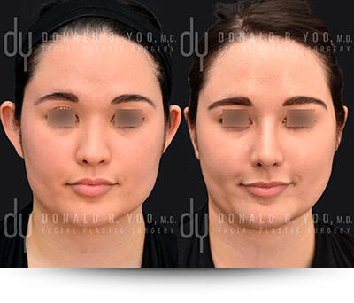 Otoplasty Before and After