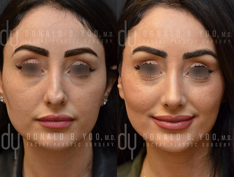 Patient Frontal View Before and After