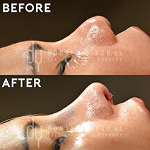 Revision rhinoplasty IntraOp profile view (before and after)