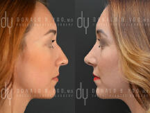 Before and after Nose Job