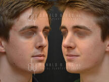 Nose Job Before and after
