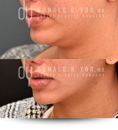 Submental Liposuction results