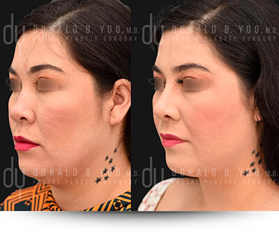 Submental Liposuction results