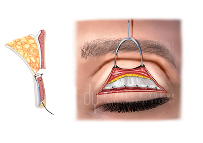 supratarsal fixation