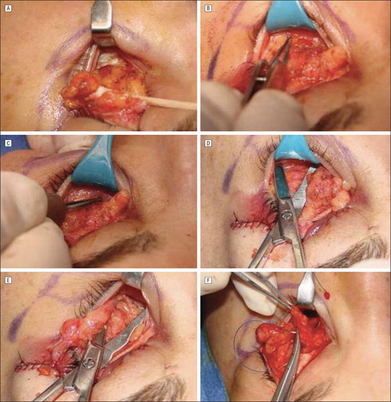 The technique of transconjunctival lower blepharoplasty with fat repositioning