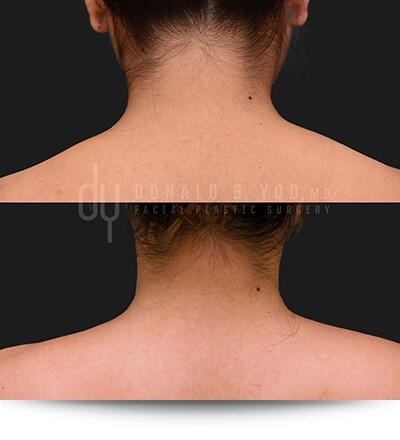 Before and After Photo of Trapezius Slimming Back View
