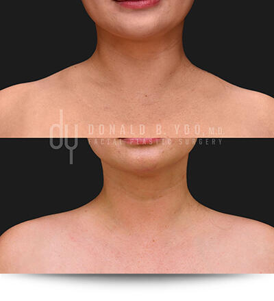 Before and After Photo Trapezius Slimming Results Front View