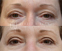 Upper Blepharoplasty surgical procedure (before and after)