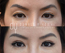 Upper Blepharoplasty surgical procedure (before and after)