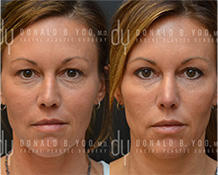 Upper Blepharoplasty surgical procedure (before and after)