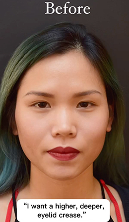 Asian Blepharoplasty