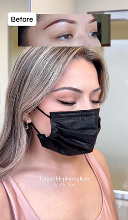 Asian Blepharoplasty