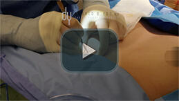 Asian Rhinoplasty in 1 Minute