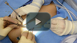 Rib Cartilage Harvest - rib