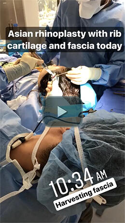 Asian Rhinoplasty with rib cartilage and fascia